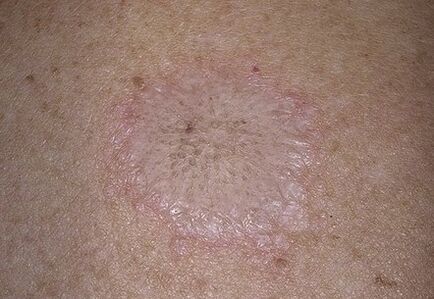 The phenomenon of Stearine Spot