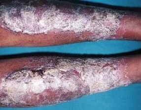 Oil from psoriasis