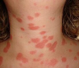 The phenomenon of Stearine Spot
